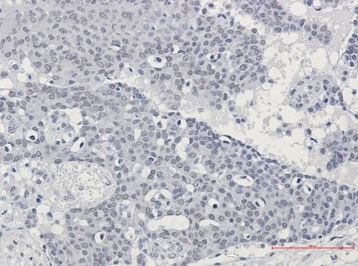 Immunohistochemistry-Paraffin: SUPT5H Antibody (S01-5C2) [NBP3-20004] - Immunohistochemistry of SUPT5H in paraffin-embedded Human breast cancer tissue using NBP3-20004 at dilution 1/50