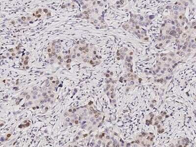 Immunohistochemistry-Paraffin: SUV39H2 Antibody [NBP2-98968] - Immunochemical staining of human SUV39H2 in human breast carcinoma with rabbit polyclonal antibody (1:500, formalin-fixed paraffin embedded sections).