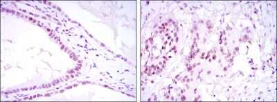 Immunohistochemistry-Paraffin: SUZ12 Antibody (3D10) [NBP1-51687] - Immunohistochemical analysis of paraffin-embedded kidney convoluted tubule tissues (left) and esophageal cancer tissues (right) using SUZ12 mouse mAb with DAB staining.