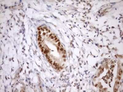 Immunohistochemistry: SYF2 Antibody (6A5) [NBP2-46033] - Analysis of Carcinoma of Human pancreas tissue. (Heat-induced epitope retrieval by Tris-EDTA, pH8.0)