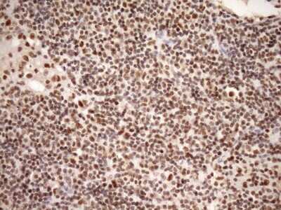 Immunohistochemistry: SYF2 Antibody (6A5) [NBP2-46033] - Analysis of Carcinoma of Human bladder tissue. (Heat-induced epitope retrieval by Tris-EDTA, pH8.0)