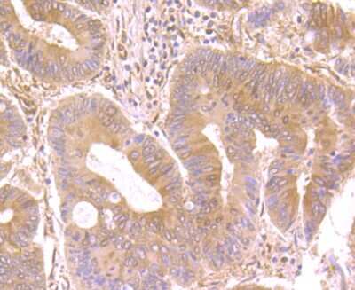 Immunohistochemistry-Paraffin: SYNE1 Antibody (JB35-26) [NBP2-75679] - Analysis of paraffin-embedded human colon cancer tissue using anti-Nesprin 1 antibody. Counter stained with hematoxylin.