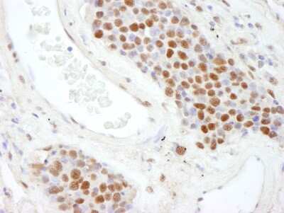 Immunohistochemistry: Scaffold attachment factor B2 Antibody [NB100-58791] - Sample: FFPE section of human small cell lung cancer. Antibody: Affinity purified rabbit anti- SAFB2 used at a dilution of 1:200 (1ug/ml). Detection: DAB