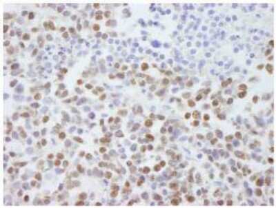 Immunohistochemistry-Paraffin: Scaffold attachment factor B2 Antibody [NB100-58791] - FFPE section of non-small cell lung cancer.  Affinity purified rabbit anti-SAFB2 used at a dilution of 1:500.