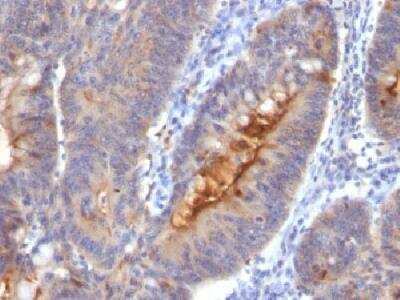 Immunohistochemistry-Paraffin: pIgR Antibody (SC05) - Azide and BSA Free [NBP2-47138] - Formalin-fixed, paraffin-embedded human Colon Carcinoma.