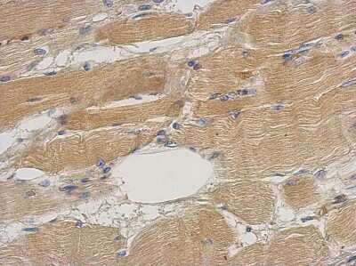 Immunohistochemistry-Paraffin: Septin-2 Antibody [NBP2-20301] - Immunohistochemical analysis of paraffin-embedded Gastric ca, using antibody at 1:500 dilution.