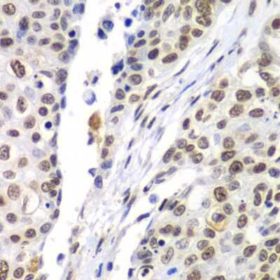 Immunohistochemistry-Paraffin: Septin-7 Antibody [NBP2-95090] - Paraffin-embedded human lung cancer using Septin-7 .