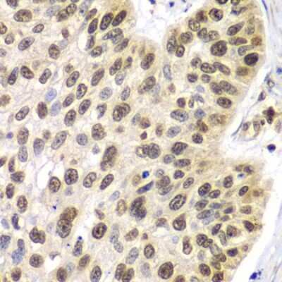 Immunohistochemistry-Paraffin: Septin-7 Antibody [NBP3-03670] - Paraffin-embedded human lung cancer using Septin-7 antibody at dilution of 1:100 (40x lens).