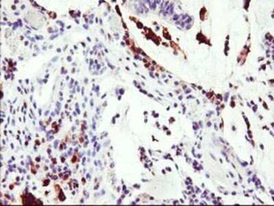 Immunohistochemistry: Serine Dehydratase Antibody (OTI3D3) - Azide and BSA Free [NBP2-74074] - Staining of paraffin-embedded Adenocarcinoma of Human colon tissue using anti-Serine Dehydratase mouse monoclonal antibody.