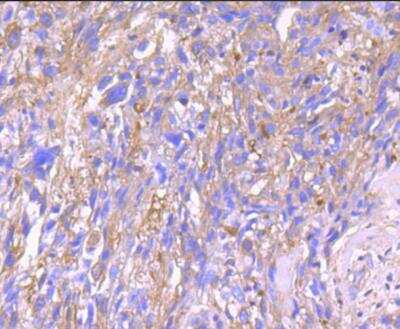 Immunohistochemistry-Paraffin: Serpin A1/alpha 1-Antitrypsin Antibody (JF10-03) [NBP2-67135] - Analysis of paraffin-embedded human breast carcinoma tissue using anti-alpha 1 Antitrypsin antibody. Counter stained with hematoxylin.