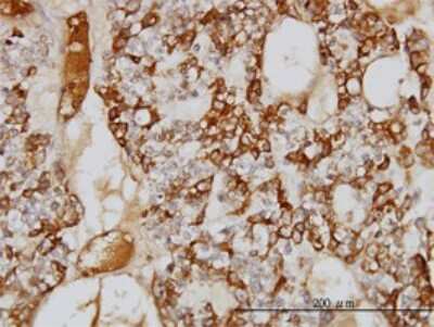 Immunohistochemistry-Paraffin: Serpin A3/alpha 1-Antichymotrypsin Antibody (1E6) [H00000012-M01] - Analysis of monoclonal antibody to SERPINA3 on formalin-fixed paraffin-embedded human ovary, clear cell carcinoma. Antibody concentration 1 ug/ml.