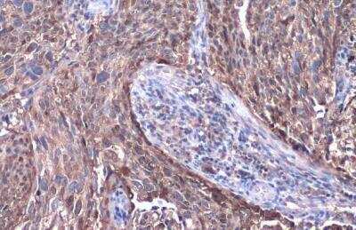 Immunohistochemistry-Paraffin: Serpin B3/SCCA1 Antibody [NBP2-20310] - Serpin B3 antibody detects Serpin B3 protein at cytoplasm by immunohistochemical analysis. Sample: Paraffin-embedded human cervical carcinoma. Serpin B3 stained by Serpin B3 antibody diluted at 1:500.