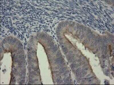 Immunohistochemistry-Paraffin: Serpin B3/SCCA1 Antibody (OTI3C2) [NBP2-03483] - Staining of paraffin-embedded Adenocarcinoma of Human endometrium tissue using anti-SerpinB3 mouse monoclonal antibody.