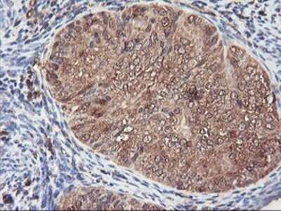 Immunohistochemistry: Serpin B6 Antibody (OTI1C5) - Azide and BSA Free [NBP2-74111] - Staining of paraffin-embedded Adenocarcinoma of Human endometrium tissue using anti-SerpinB6 mouse monoclonal antibody.