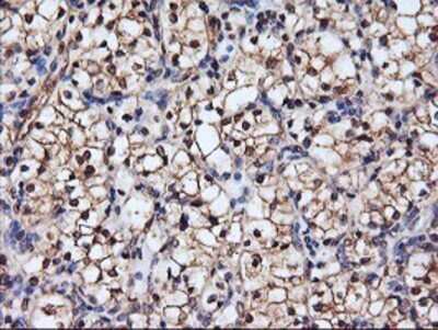 Immunohistochemistry: Serpin B6 Antibody (OTI1C5) - Azide and BSA Free [NBP2-74111] - Staining of paraffin-embedded Carcinoma of Human kidney tissue using anti-SerpinB6 mouse monoclonal antibody.