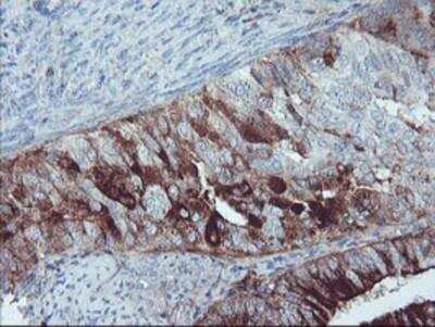 Immunohistochemistry-Paraffin: Serpin E2/PN1 Antibody (2C9) [NBP2-01984] - Staining of paraffin-embedded Adenocarcinoma of Human endometrium tissue using anti-SERPINE2 mouse monoclonal antibody.