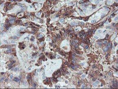 Immunohistochemistry-Paraffin: Serpin E2/PN1 Antibody (2C9) [NBP2-01984] - Staining of paraffin-embedded Adenocarcinoma of Human ovary tissue using anti-SERPINE2 mouse monoclonal antibody.