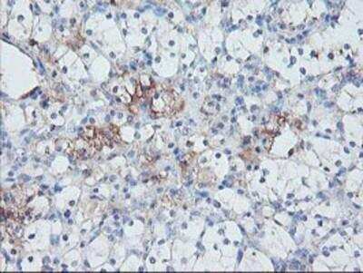 Immunohistochemistry-Paraffin: Serpin E2/PN1 Antibody (2C9) [NBP2-01984] - Staining of paraffin-embedded Carcinoma of Human kidney tissue using anti-SERPINE2 mouse monoclonal antibody.