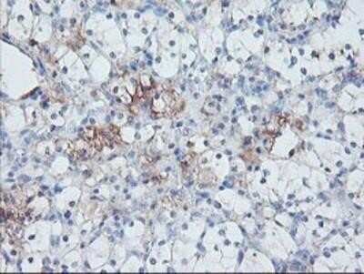 Immunohistochemistry: Serpin E2/PN1 Antibody (OTI2C9) - Azide and BSA Free [NBP2-74117] - Staining of paraffin-embedded Carcinoma of Human kidney tissue using anti-SERPINE2 mouse monoclonal antibody.