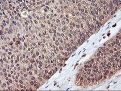 Immunohistochemistry-Paraffin: SerpinB6 Antibody (1C5) [NBP2-01650] - Staining of paraffin-embedded Carcinoma of Human bladder tissue using anti-SerpinB6 mouse monoclonal antibody.