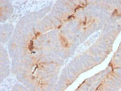 Immunohistochemistry-Paraffin: Serum Amyloid A1/A2 Antibody (SAA/2868R) - Azide and BSA Free [NBP3-08413] - Formalin-fixed, paraffin-embedded human Colon Carcinoma stained with Serum Amyloid A1/A2 Recombinant Rabbit Monoclonal Antibody (SAA/2868R).