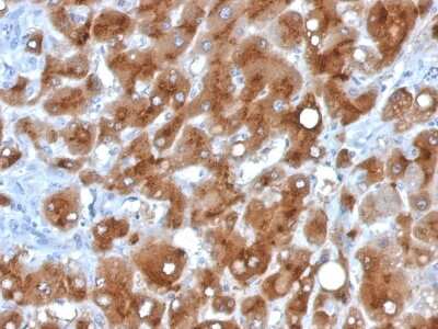 Immunohistochemistry-Paraffin: Serum Amyloid A1/A2 Antibody (SAA/326) - Azide and BSA Free [NBP3-08412] - Formalin-fixed, paraffin-embedded human Hepatocellular Carcinoma stained with Serum Amyloid A1/A2 Mouse Monoclonal Antibody (SAA/326).