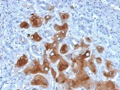 Immunohistochemistry-Paraffin: Serum Amyloid A1/A2 Antibody (SAA/326) [NBP3-07766] - Formalin-fixed, paraffin-embedded human Hepatocellular Carcinoma stained with Serum Amyloid A1/A2 Mouse Monoclonal Antibody (SAA/326).