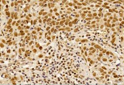 Immunohistochemistry-Paraffin: Shugoshin Antibody [NBP1-03361] - IHC analysis of formalin-fixed paraffin-embedded tissue section of human pulmonary squamous cell carcinoma using rabbit polyclonal Shugoshin antibody (NBP1-03361) at 5 ug/ml concentration. The carcinoma cells depicted a distinct nuclear with weak cytoplasmic immuno-reactivity for Shugoshin protein [Magnification 40X]