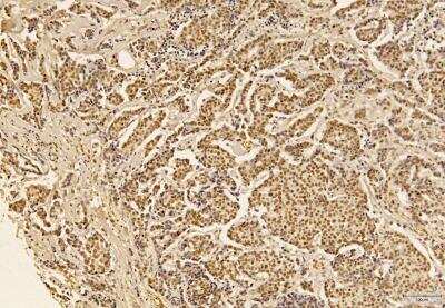 Immunohistochemistry-Paraffin: Shugoshin Antibody [NBP1-03361] - IHC analysis of formalin-fixed paraffin-embedded tissue section of infiltrating ductal carcinoma of human breast using rabbit polyclonal Shugoshin antibody (NBP1-03361) at 5 ug/ml concentration. The carcinoma cells depicted a moderate to strong nuclear with weak cytoplasmic immunopositivity of Shugoshin protein, whereas, the collagen fibers in the surrounding tumor stroma/connective tissue also developed a very weak/potentially nonspecific staining [Magnification 40X].