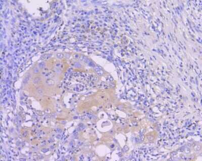 Immunohistochemistry-Paraffin: Sirtuin 1/SIRT1 Antibody (SZ04-01) [NBP2-67364] - Immunohistochemical analysis of paraffin-embedded human lung carcinoma tissue using anti-Sirtuin 1/SIRT1 antibody. The section was pre-treated using heat mediated antigen retrieval with Tris-EDTA buffer (pH 8.0-8.4) for 20 minutes. The tissues were blocked in 5% BSA for 30 minutes at room temperature, washed with ddH2O and PBS, and then probed with the primary antibody (ET1603-3, 1/50) for 30 minutes at room temperature. The detection was performed using an HRP conjugated compact polymer system. DAB was used as the chromogen. Tissues were counterstained with hematoxylin and mounted with DPX.