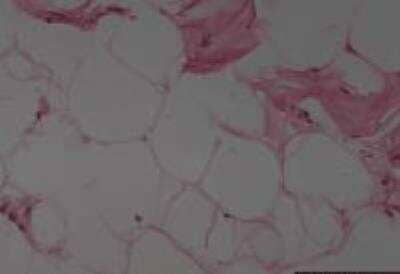 Hematoxylin & Eosin Stain: Skin Lipoma Tissue Slides (Tumor) [NBP2-30244] -  skin, lipoma  Age/Sex : 55/F