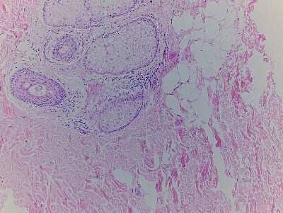 Hematoxylin & Eosin Stain: Skin Tissue Slides (Tumor) [NBP2-77960] - Tissue: Human Skin,  Pathology: Tumor