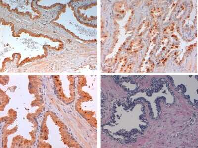 Immunohistochemistry: Slit2 Antibody [NB600-881] - Analysis of human breast carcinoma Tissue: Human prostate Fixation: FFPE buffered formalin 10% conc Ag Retrieval: Heat, Citrate pH 6.2. Pressure Cooker, EDTA pH 9.5 Pressure Cooker Primary antibody: 2ug/ml 1.5 hour @ room T Secondary Ab: MACH 1 HRP POLYMER 1:50 45” RT