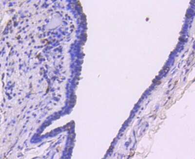Immunohistochemistry-Paraffin: Smad3 Antibody (SY25-01) [NBP2-67434] - Analysis of paraffin-embedded human breast carcinoma tissue using anti-Smad3 antibody. Counter stained with hematoxylin.