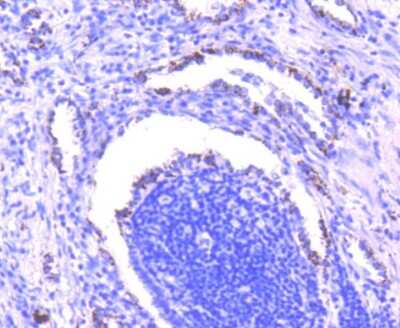 Immunohistochemistry-Paraffin: Smad3 Antibody (SY25-01) [NBP2-67434] - Analysis of paraffin-embedded human lung cancer tissue using anti-Smad3 antibody. Counter stained with hematoxylin.