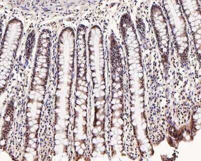 Immunohistochemistry-Paraffin: Smad3 [p Ser423, p Ser425] Antibody (ST0493) [NBP2-67513] - Analysis of paraffin-embedded human large intestine tissue with Rabbit anti-Phospho-Smad3 [p Ser423, p Ser425] antibody washed with ddH2O and PBS, and then probed with the primary antibody  at 1/200 dilution for 1 hour at room temperature. The detection was performed using an HRP conjugated compact polymer system. DAB was used as the chromogen. Tissues were counterstained with hematoxylin and mounted with DPX.