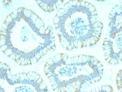 Immunohistochemistry-Paraffin: Smad4 Antibody (SMAD4/2440) [NBP3-08320] - Formalin-fixed, paraffin-embedded human Colon Carcinoma stained with Smad4 Mouse Monoclonal Antibody (Smad4/2440).