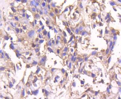 Immunohistochemistry-Paraffin: Smad4 Antibody (SP05-05) [NBP2-67372] - Analysis of paraffin-embedded human breast carcinoma tissue using anti-Smad4 antibody. Counter stained with hematoxylin.