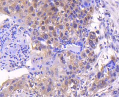 Immunohistochemistry-Paraffin: Smad4 Antibody (SP05-05) [NBP2-67372] - Analysis of paraffin-embedded human lung cancer tissue using anti-Smad4 antibody. Counter stained with hematoxylin.