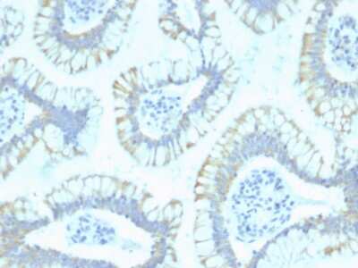 Immunohistochemistry-Paraffin: Smad4 Antibody (SPM448) - Azide and BSA Free [NBP3-08344] - Formalin-fixed, paraffin-embedded human Colon Carcinoma stained with Smad4 Mouse Monoclonal Antibody (SPM448).