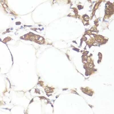 Immunohistochemistry-Paraffin: Smad7 Antibody [NBP2-94047] - Paraffin-embedded human breast cancer using Smad7 .