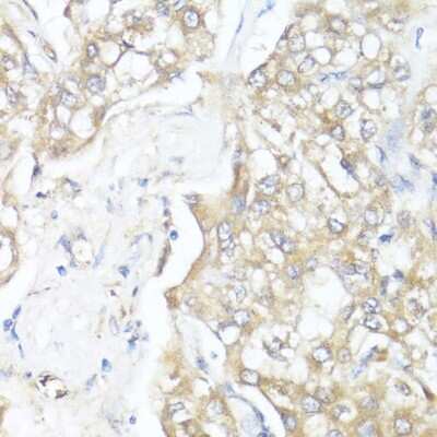 Immunohistochemistry-Paraffin: Smad7 Antibody [NBP2-94047] - Paraffin-embedded human liver cancer using Smad7 .