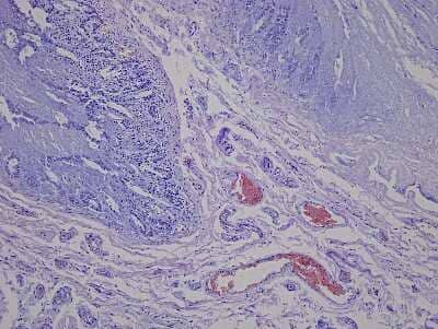 Hematoxylin & Eosin Stain: Small Intestine Jejunum Tissue Slides (Diabetes) [NBP2-77898] - Tissue: Human Small Intestine (Jejunum),  Pathology: Diabetes