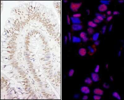 <b>Independent Antibodies Validation and Biological Strategies Validation.</b>Immunohistochemistry: Smek1 Antibody [NB100-2879] - Sample: FFPE sections of human colon carcinoma (left) and breast carcinoma (right). Antibody: Affinity purified rabbit anti- PPP4R3 Alpha used at a dilution of 1:200 (1ug/ml) and 1:80 (2.5 ug/ml). Detection: DAB and Red-fluorescent Goat anti-Rabbit IgG-he