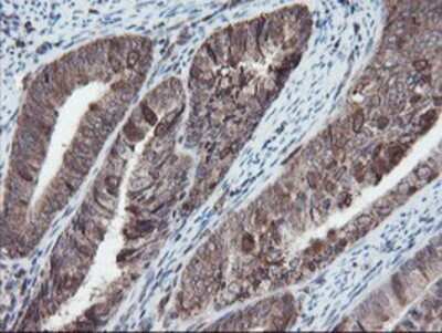 Immunohistochemistry: SnoN Antibody (OTI3E2) - Azide and BSA Free [NBP2-74255] - Staining of paraffin-embedded Adenocarcinoma of Human endometrium tissue using anti-SnoN mouse monoclonal antibody.