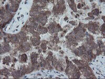Immunohistochemistry: SnoN Antibody (OTI3E2) - Azide and BSA Free [NBP2-74255] - Staining of paraffin-embedded Adenocarcinoma of Human ovary tissue using anti-SnoN mouse monoclonal antibody.