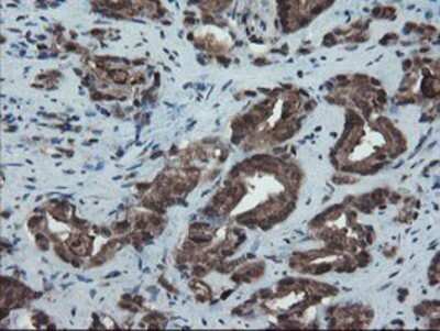 Immunohistochemistry: SnoN Antibody (OTI3E2) - Azide and BSA Free [NBP2-74255] - Staining of paraffin-embedded Carcinoma of Human prostate tissue using anti-SnoN mouse monoclonal antibody.