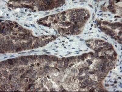 Immunohistochemistry: SnoN Antibody (OTI3F6) - Azide and BSA Free [NBP2-74254] - Analysis of Adenocarcinoma of Human ovary tissue.
