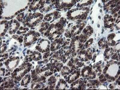 Immunohistochemistry: SnoN Antibody (OTI3F6) - Azide and BSA Free [NBP2-74254] - Analysis of Carcinoma of Human thyroid tissue.