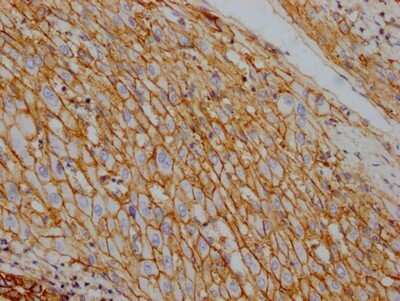 Immunohistochemistry: Sodium Potassium ATPase Alpha 1 Antibody (4C3) [NBP3-15239] - IHC image of Sodium Potassium ATPase Alpha 1 antibody diluted at 1:100 and staining in paraffin-embedded human liver cancer. After dewaxing and hydration, antigen retrieval was mediated by high pressure in a citrate buffer (pH 6.0). Section was blocked with 10% normal goat serum 30 minutes at RT. Then primary antibody (1% BSA) was incubated at 4C overnight. The primary is detected by a Goat anti-rabbit IgG polymer labeled by HRP and visualized using 0.05% DAB.